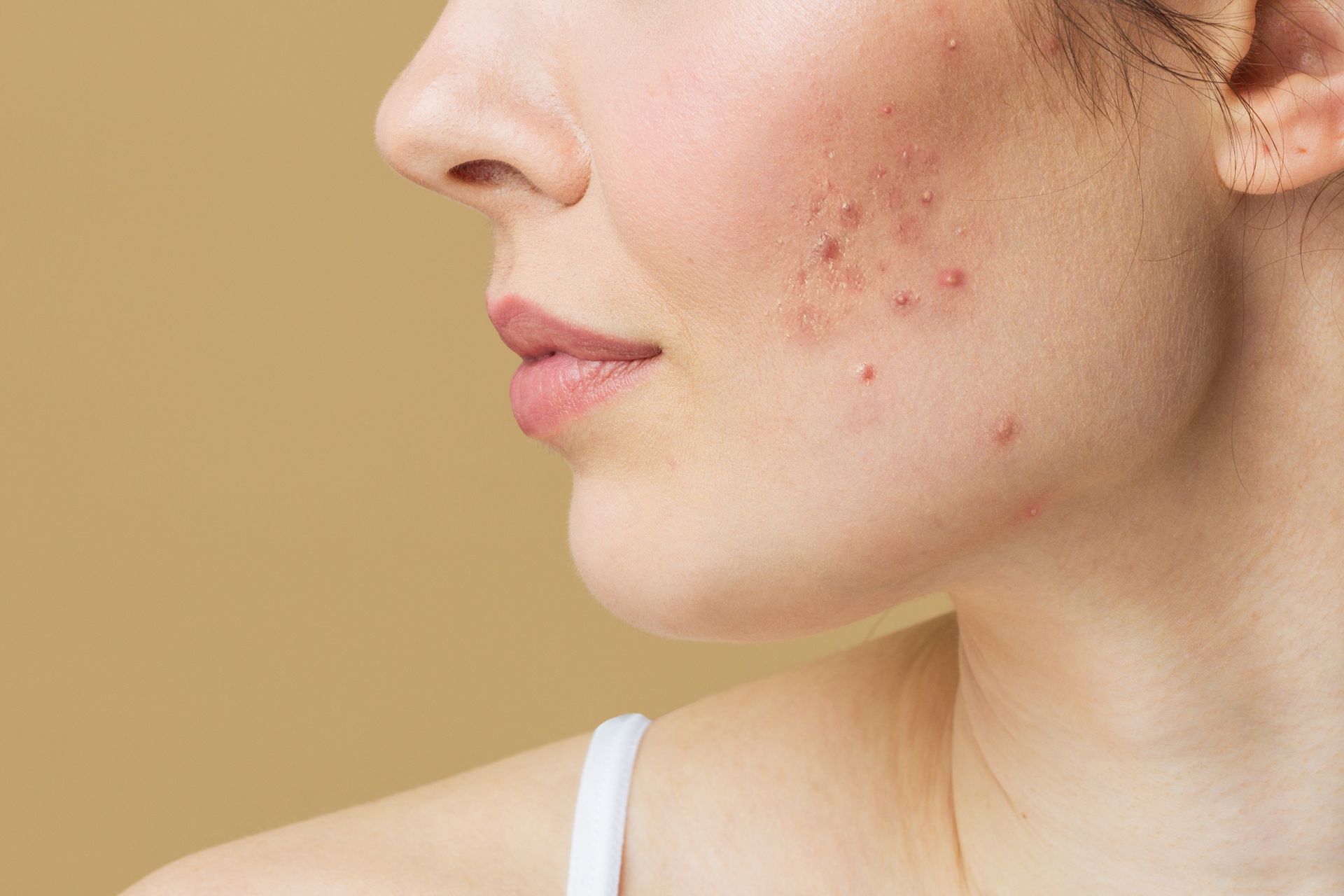 A close up of a woman 's face with acne on it.